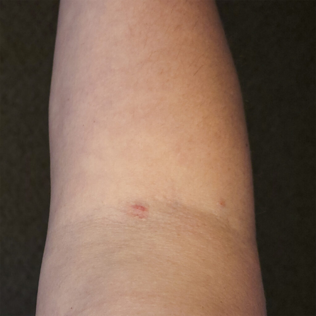 IV marks in my inner elbow. Center is the failed attempt, right is the successful attempt.